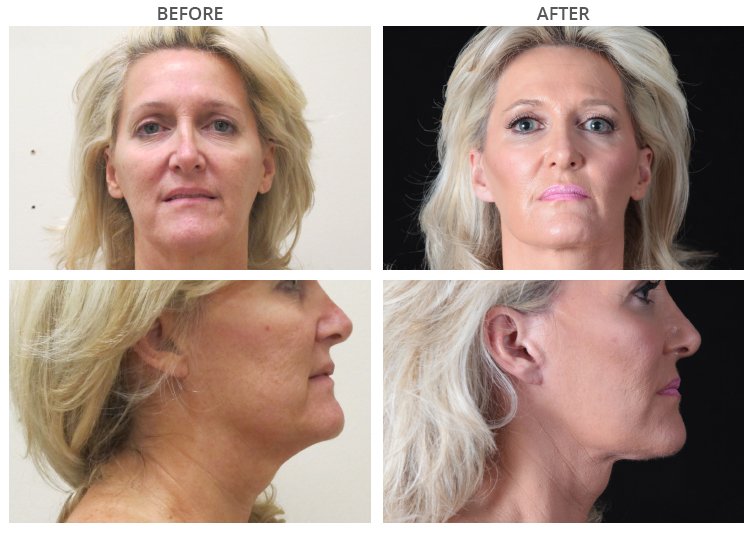 The Benefits of a Face Lift Surgery