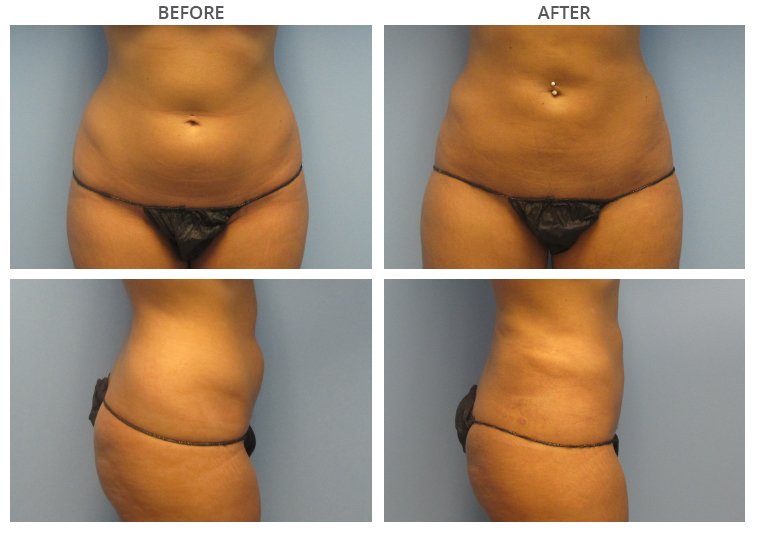 The Benefits of Ultrasound Assisted Liposuction