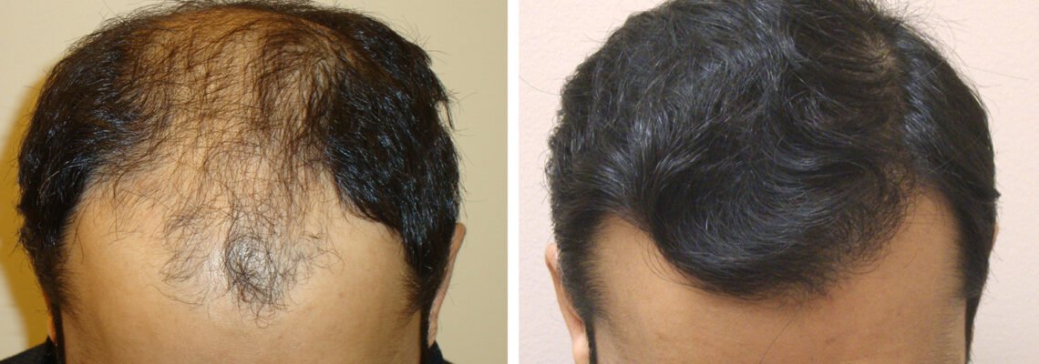 Aesthetics Hair Restoration