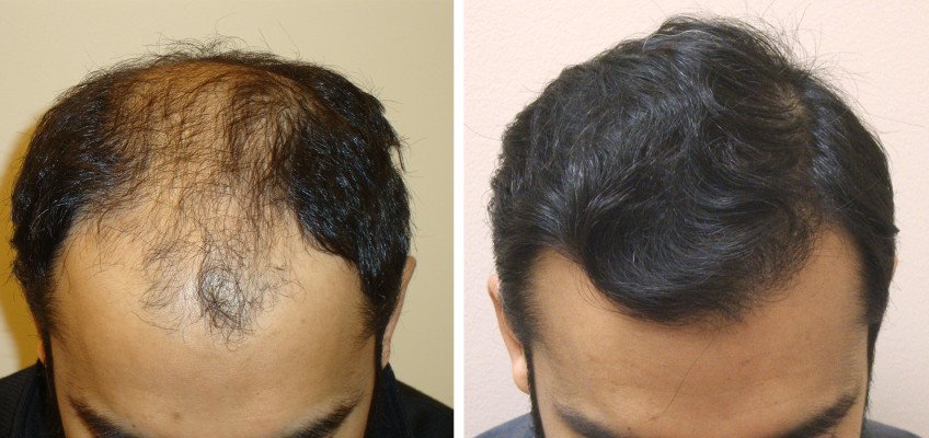 Aesthetics Hair Restoration