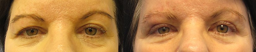 The Benefits of Eyelid Surgery