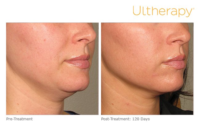 Ultherapy: A Non-invasive Neck, Brow and Under-Chin Lift