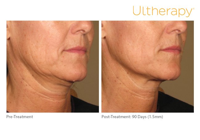 The Top 4 Myths About Ultherapy