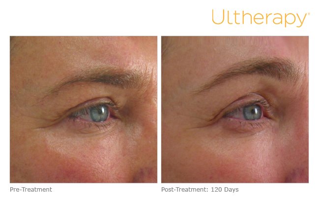 Ultherapy Brow Transformation